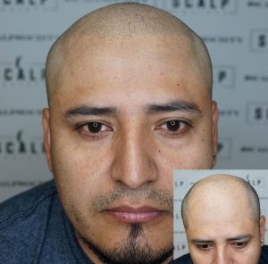 ماندگاری اسکالپ سر چقدر است؟