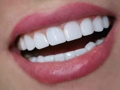 نظرات مردم درباره کامپوزیت دندان